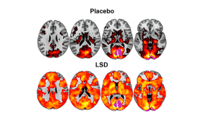 LSD and Brain Imaging