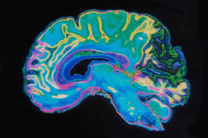 How LSD Affects The Brain
